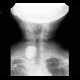 Calcification in goiter, thyroid gland: X-ray - Plain radiograph